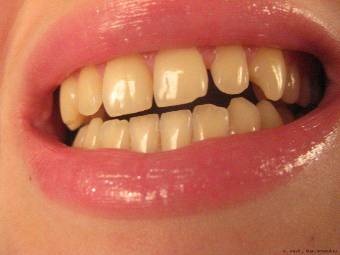 Այս սուպեր միջոցը կսպիտակեցնի անգամ ամենադեղին ատամները և կհեռացնի ատամնաքարերը