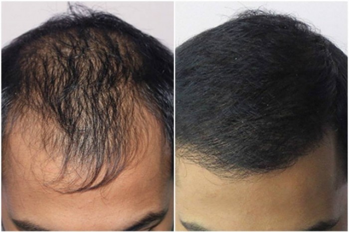 Վերականգնեք թափված մազերը՝ ընդամենը 2 բաղադրիչի օգնությամբ