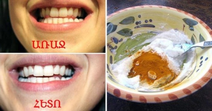 Բնական հիանալի միջոց՝ ատամների որակյալ սպիտակեցման համար