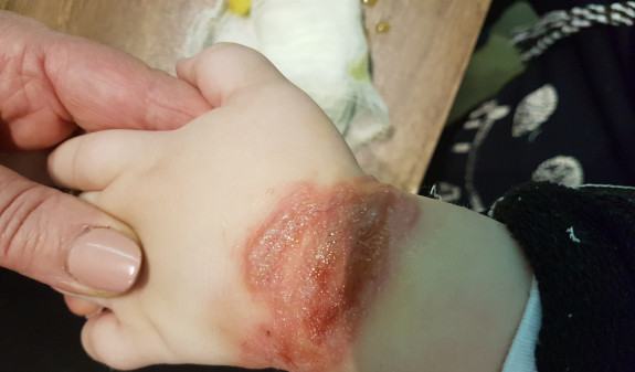 Բժշկական կենտրոնում 2-ամյա երեխայի այրվածք ստանալու փաստով ոստիկանությունում նյութեր են նախապատրաստվում
