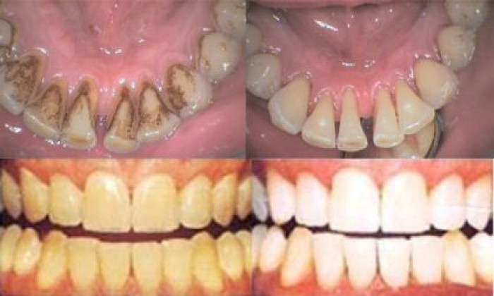 Սպիտակեցրեք ատամները ընդամենը 2 բաղադրիչի օգնությամբ