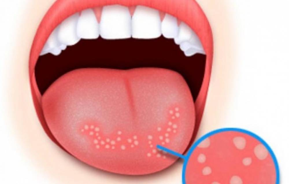 Բնական միջոցներ՝ բերանի վերքերը բուժելու համար