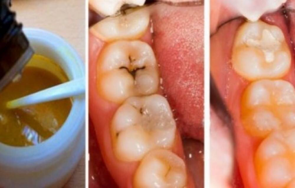 Ընդամենը 4 բաղադրիչ. ատամի այս մածուկը շուտով անգործ կթողնի ատամնաբույժներին