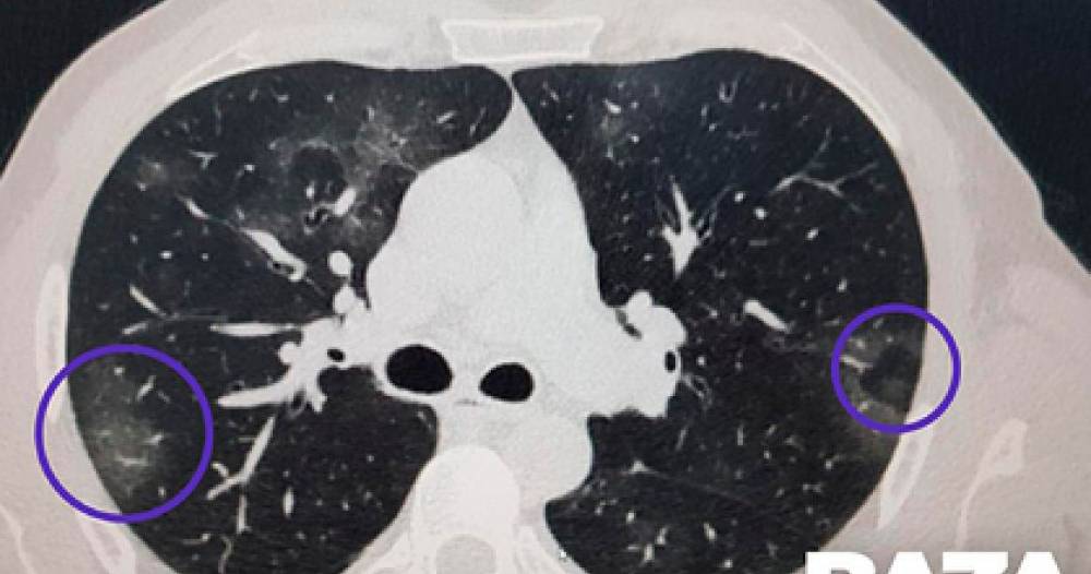Ինչպես է վարակն աստիճանաբար տարածվում կորոնավիրուսով վարակված հիվանդներից մեկի թոքերում. տեսանյութ