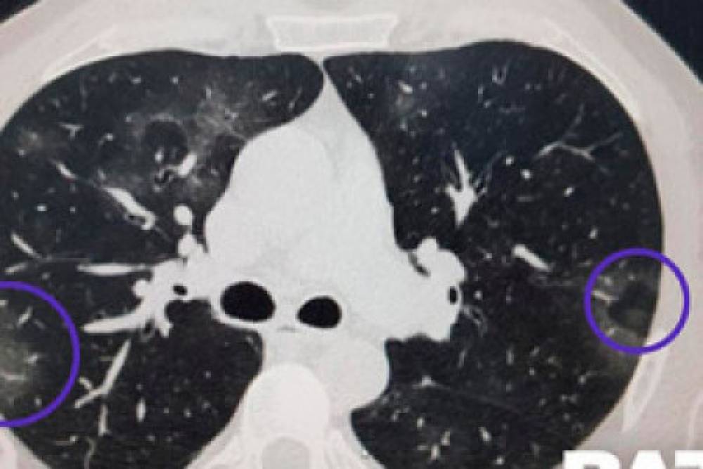 Ինչպես է կորոնավիրուսն աստիճանաբար տարածվում հիվանդի թոքերում. Baza (տեսանյութ)