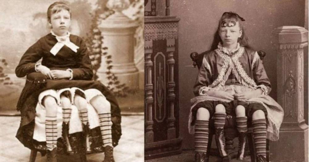 Միրտլ Կորբին՝ աշխարհի միակ աղջիկն, ով ուներ 4 ոտք