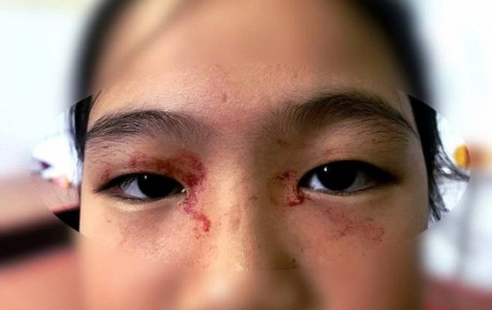 Վիետնամում 11-ամյա աղջկա դեմքին արյունոտ քրտինք է հայտնվել