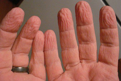 Ինչո՞ւ է ջրից մաշկը թոռոմում (տեսանյութ)