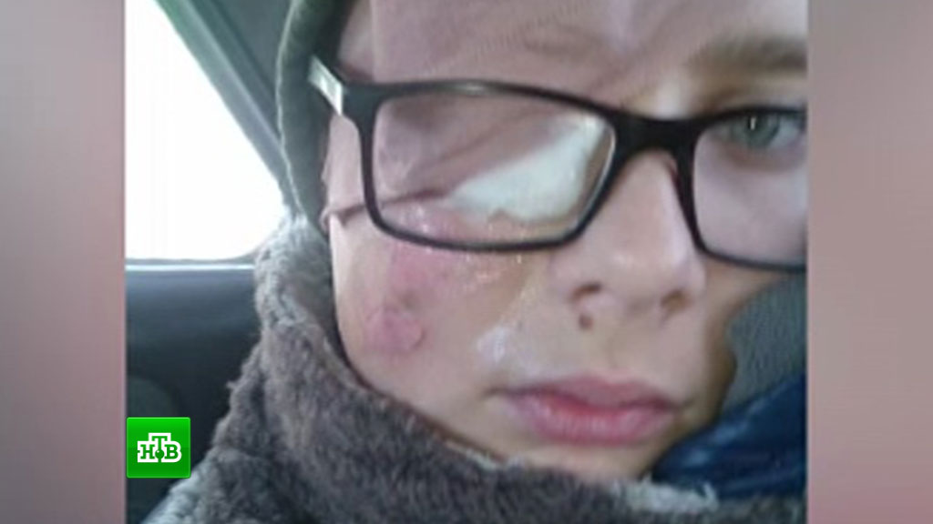 Հիվանդանոցում այրել են դպրոցական երեխայի դեմքը (տեսանյութ)