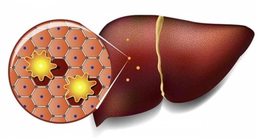 Լյարդի ճարպակալումը 27 տոկոսով ավելացնում է քաղցկեղի առաջացման հավանականությունը