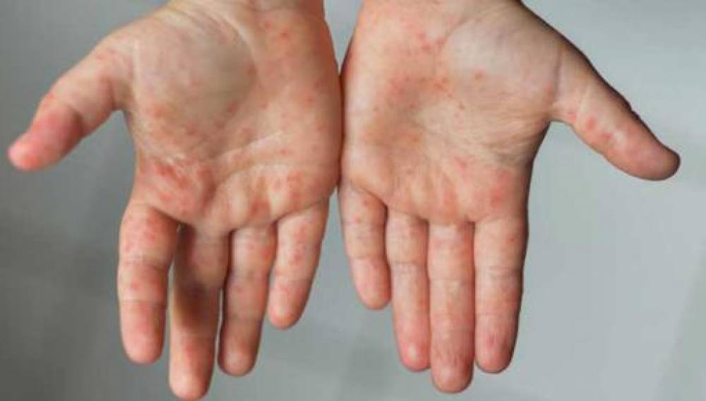 Հայաստանում կարմրուկի լաբորատոր հաստատված դեպքերի թիվը 521 է