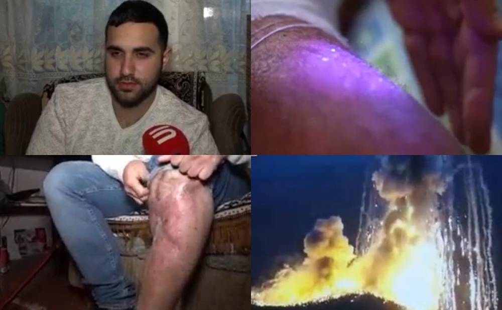 Տեսանյութ.Հրաշք է տեղի ունեցել. Ոսկորին հասած այրվածքներով հայ զինվորները. «ադրբեջանական քիմիա» ( 21+)