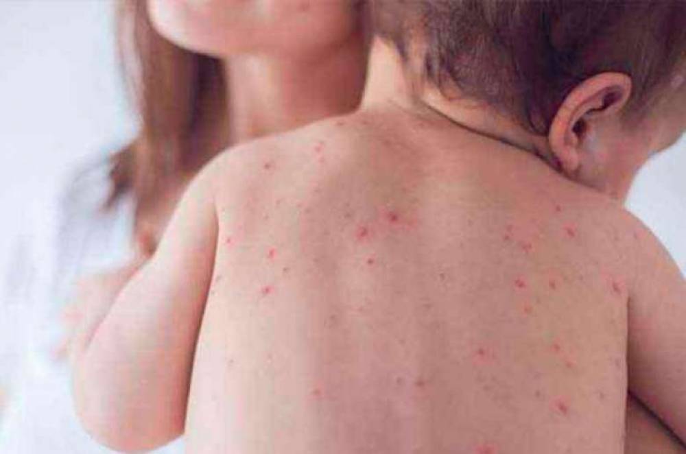 Կարմրուկի դեմ պատվաստանյութը չի առաջացնում հիվանդություն, թեև պարունակում է թուլացված վիրուս․ ՀՀ ԱՆ