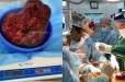 50-ամյա կնոջ լյարդից 3 կիլոգրամանոց մակաբույծ են հեռացրել