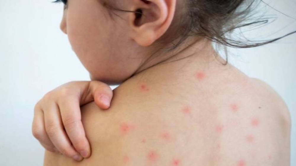 Հայաստանում հունվարի 8-ի դրությամբ՝ կարմրուկի լաբորատոր հաստատված դեպքերի թիվը 545 է