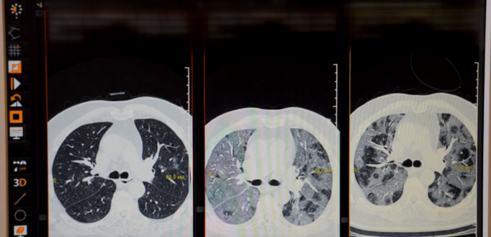 Ե՞րբ պետք է դիմել բժշկի և ի՞նչ զարգացում կարող է ունենալ ատիպիկ թոքաբորբը
