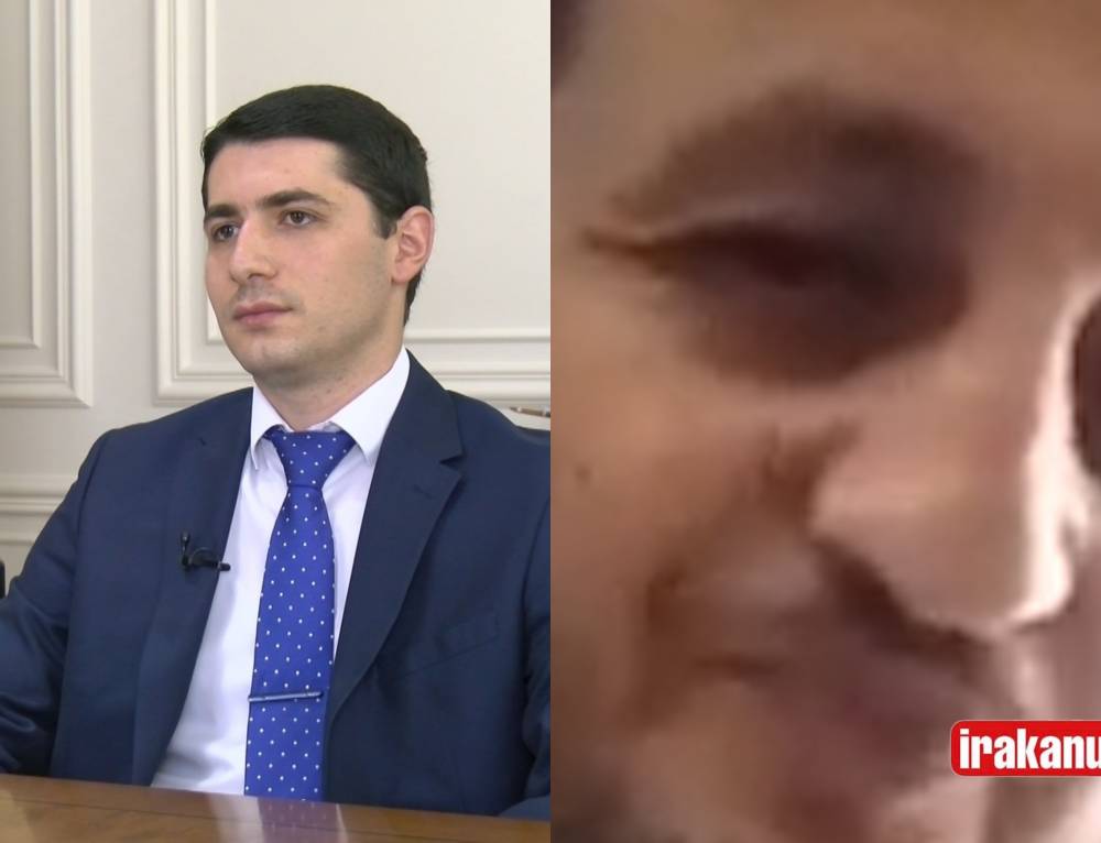 Եռման ջուր են լցրել վրես, էլեկտրաշոք կիրառել․ քաղաքացին նկարագրում է, թե ինչպես է Արգիշտի Քյարամյանն իրեն խոշտանգել