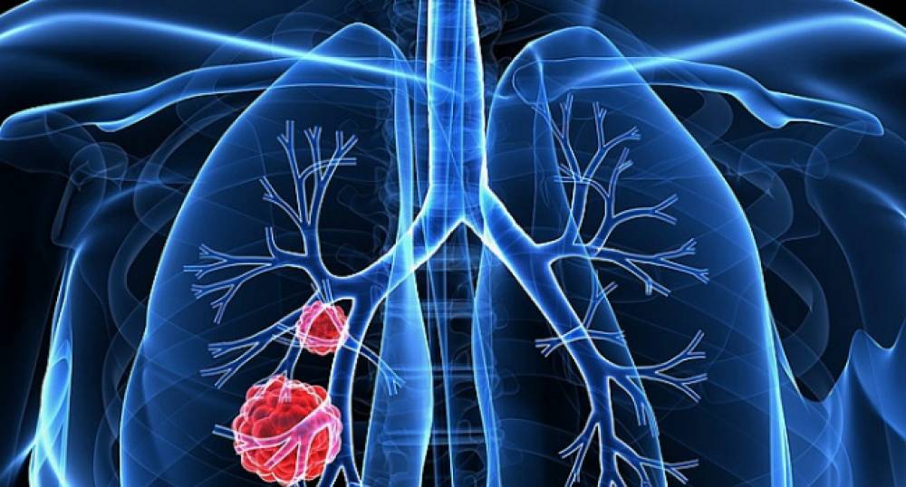 Կանաչի, որը 86%-ով սպանում է թոքերի քաղցկեղի բջիջները