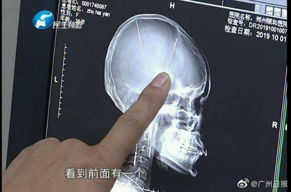 Չինուհու գլխում երկու մետաղական ասեղ է հայտնաբերվել, սակայն երիտասարդ կինը պատկերացում չունի՝ ինչպես են դրանք հայտնվել այնտեղ