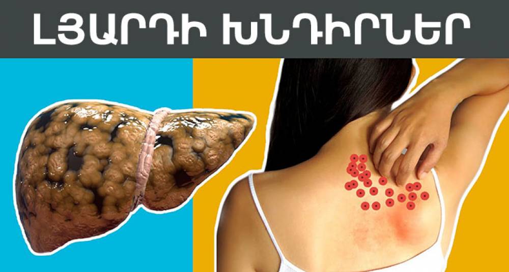 Ո՞ր նշանները կարող են վկայել լյարդի խնդիրների մասին